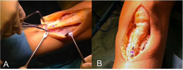 Ricostruzione del legamento patello femorale mediale mediante una piccola incisione sul bordo mediale della rotula